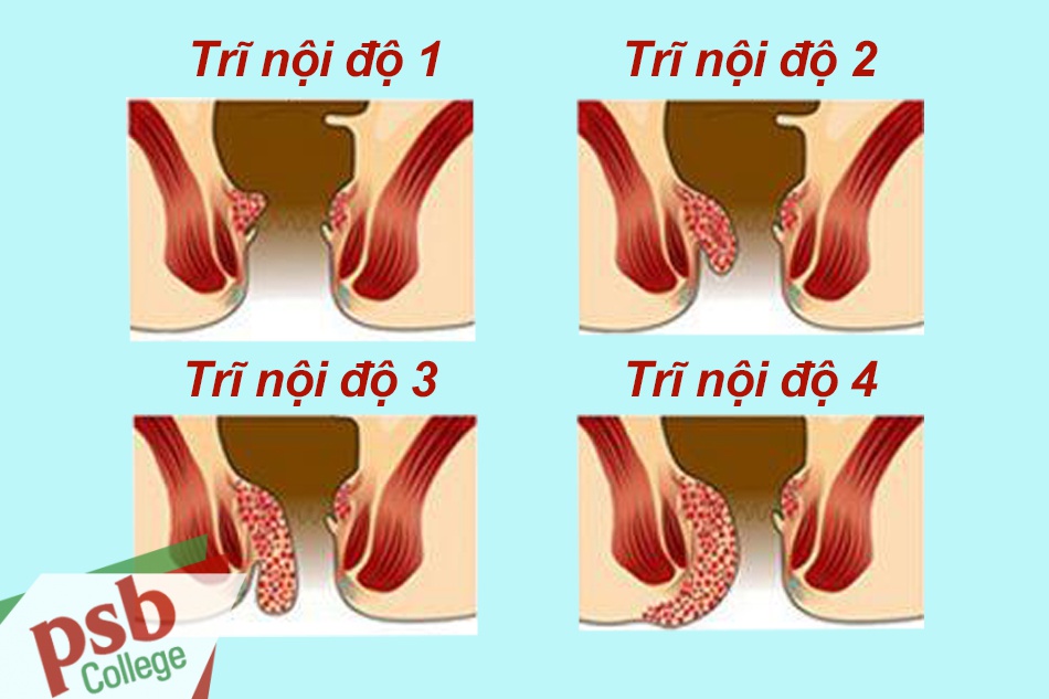 4 cấp độ của bệnh trĩ nội