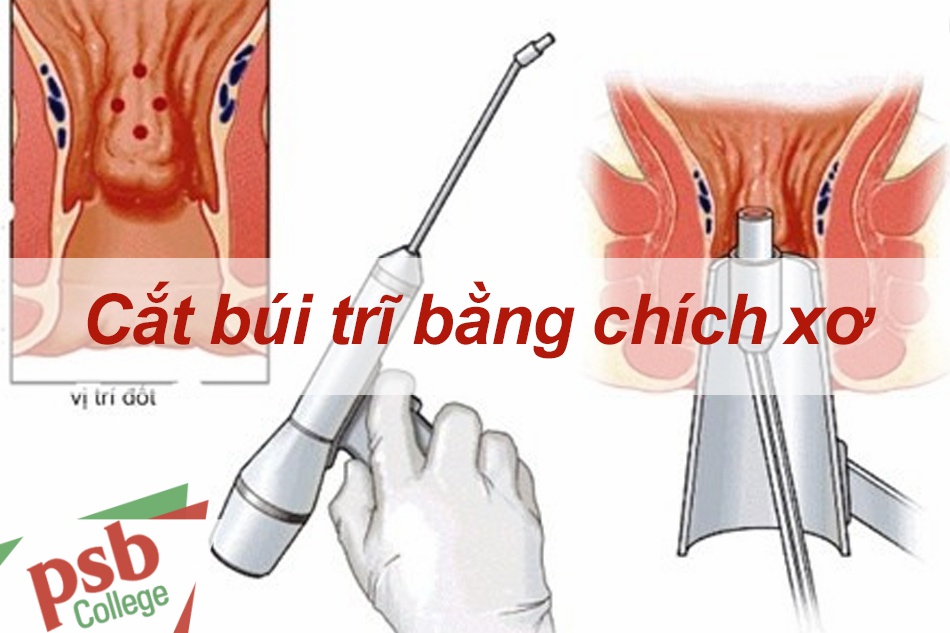 Thủ thuật cắt búi trĩ bằng chích xơ