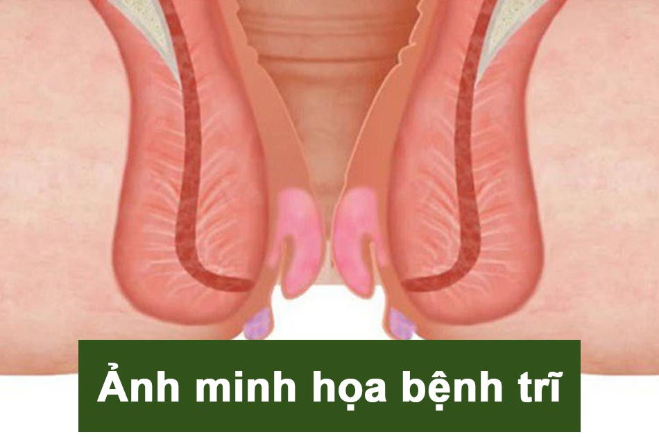 Ảnh minh họa bệnh trĩ