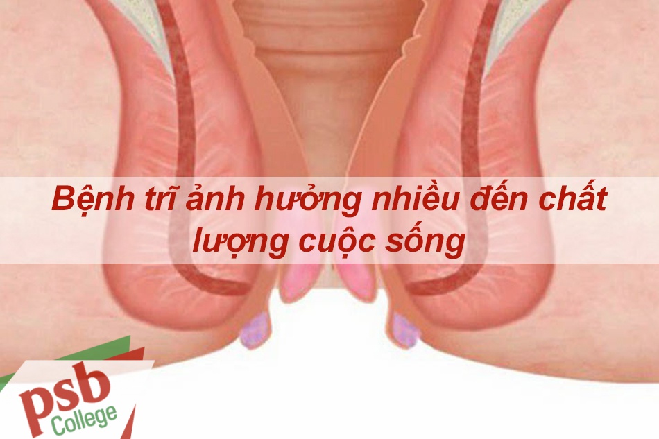 Bệnh trĩ ảnh hưởng nhiều đến cuộc sống