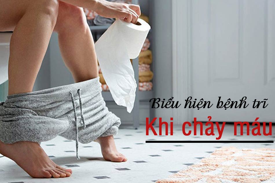 Biểu hiện của bệnh trĩ khi chảy máu