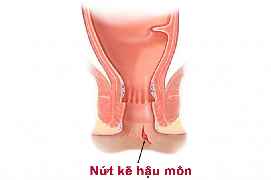 Hình ảnh nứt kẽ hậu môn