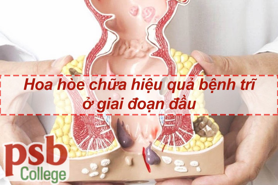 Hoa hòe chữa hiệu quả cho bệnh trĩ giai đoạn đầu