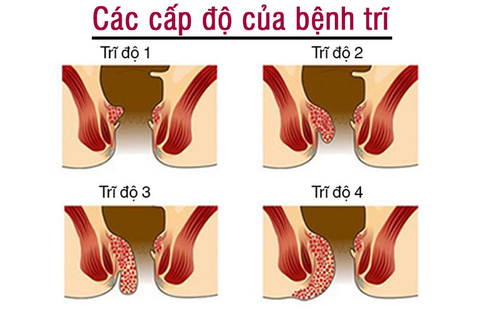 Các cấp độ của bệnh trĩ