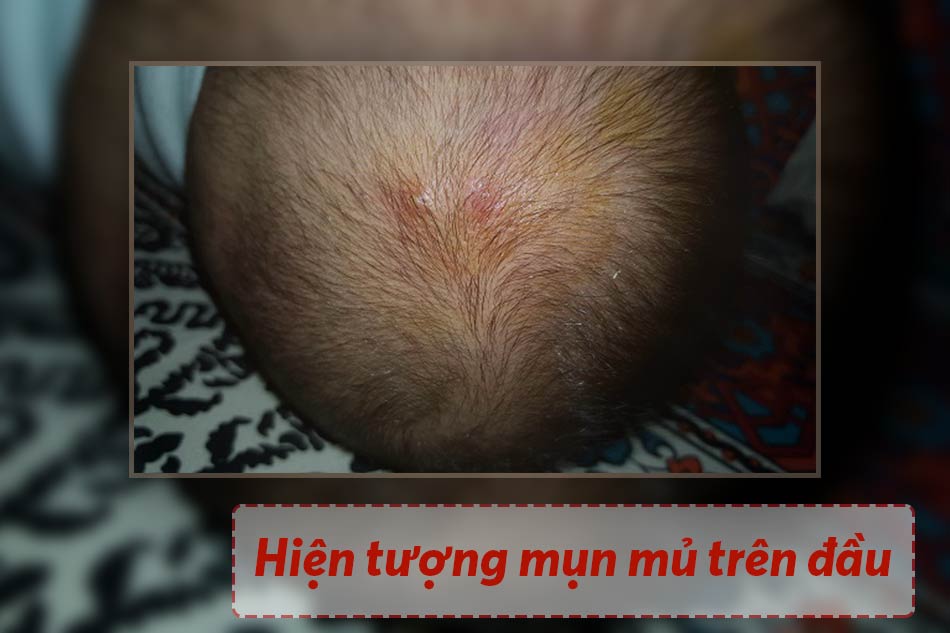 Hiện tượng mụn mủ trên đầu