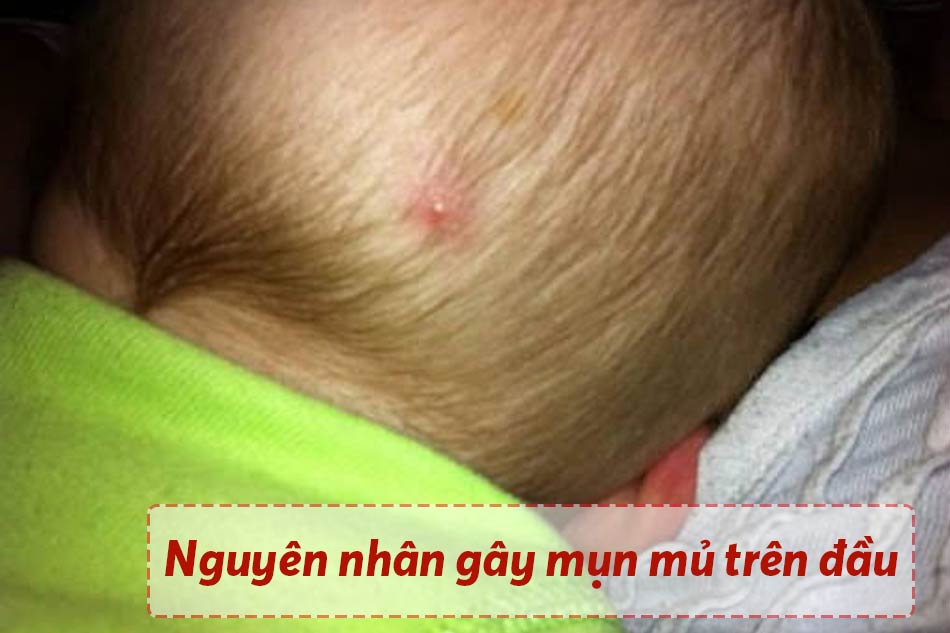 Nguyên nhân trẻ sơ sinh bị nổi mụn mủ trên đầu