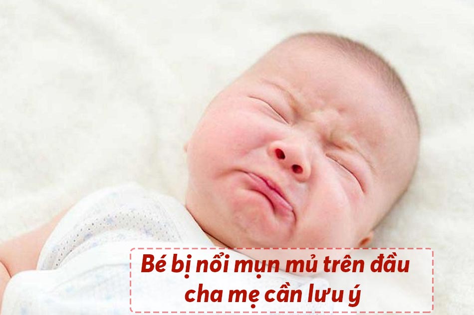 Bé bị nổi mụn mủ trên đầu cha mẹ cần lưu ý