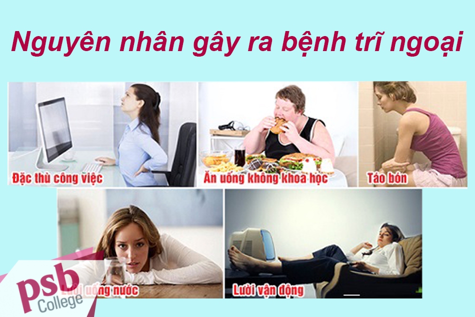 Nguyên nhân gây bệnh trĩ ngoại