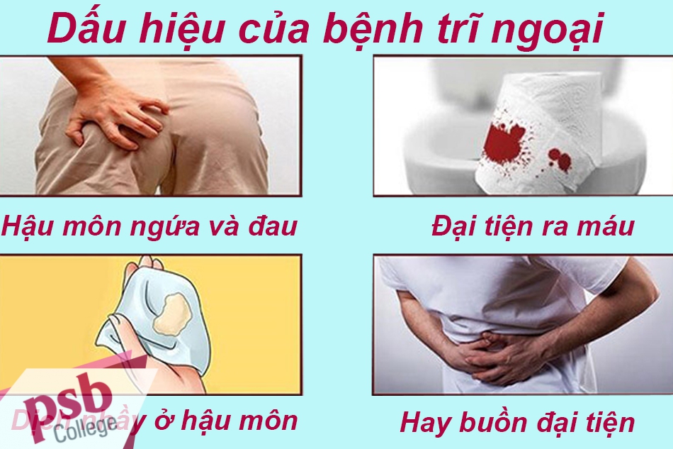 Dấu hiệu thường gặp của bệnh trĩ ngoại