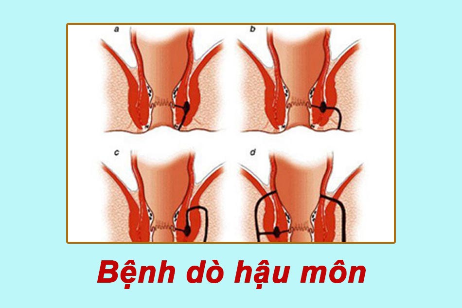 Ảnh minh họa bệnh dò hậu môn