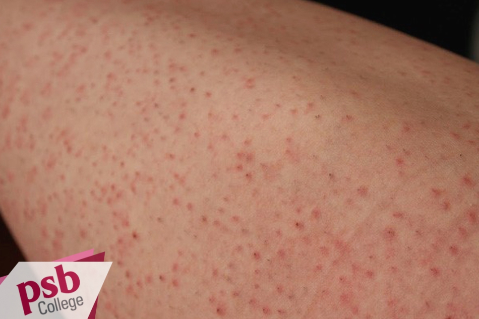 Hình ảnh của viêm nang lông