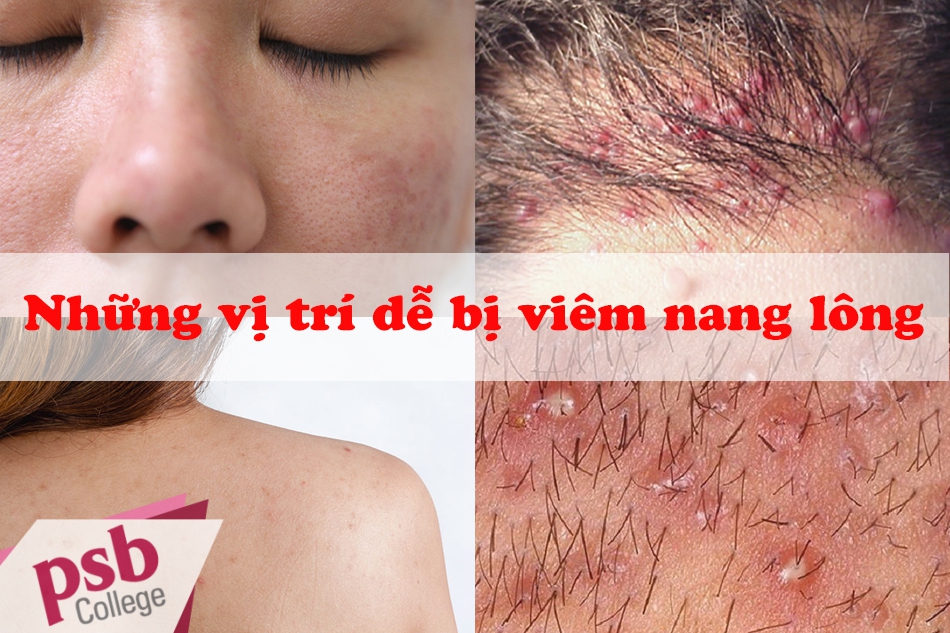 Hình ảnh viêm nang lông vùng kín cùng những vị trí khác