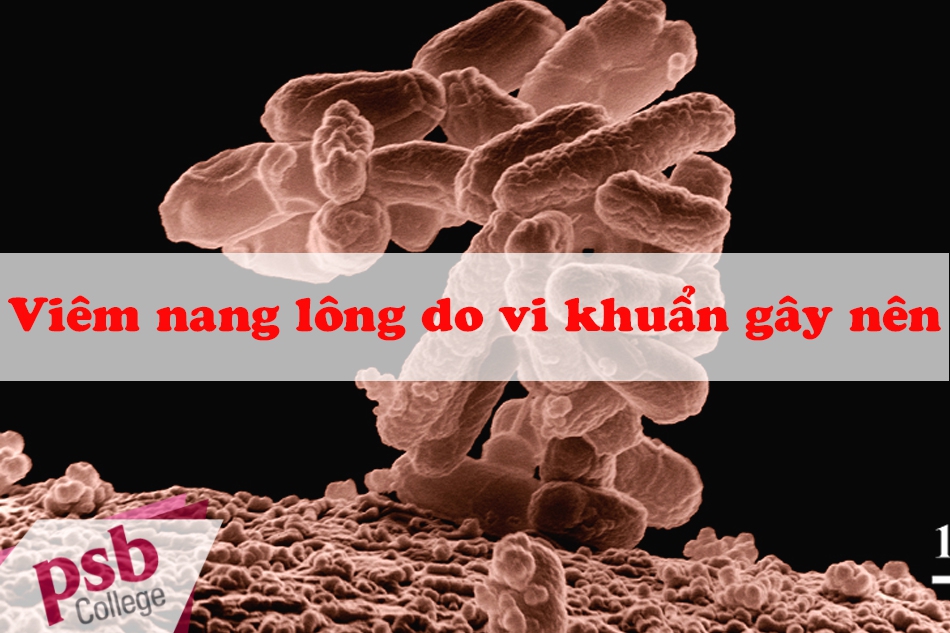 Viêm nang lông do vi khuẩn gây nên