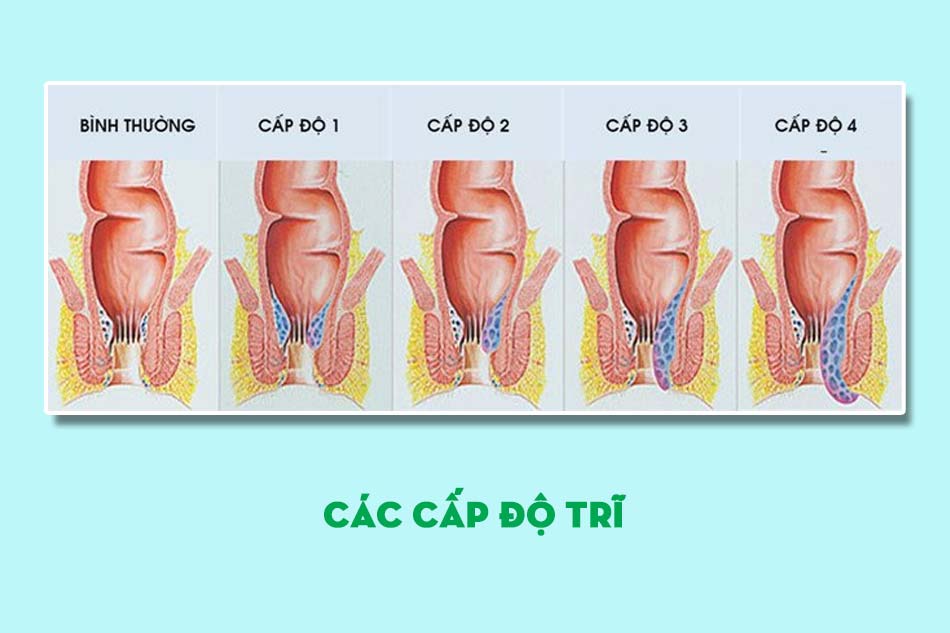 Phân loại các cấp độ bệnh trĩ