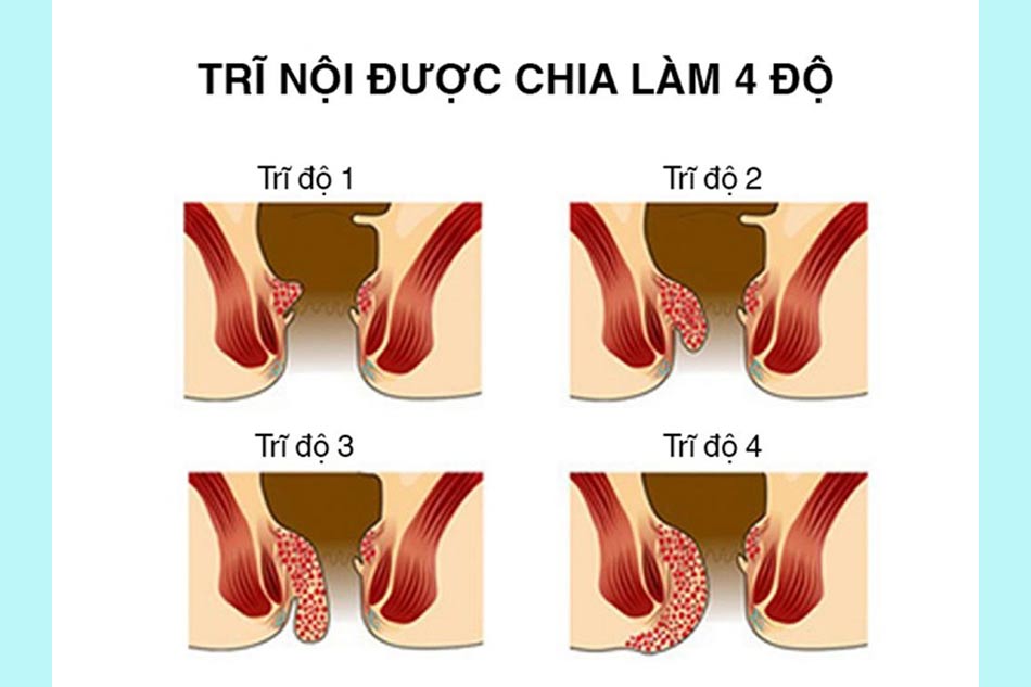 Trĩ nội là gì?
