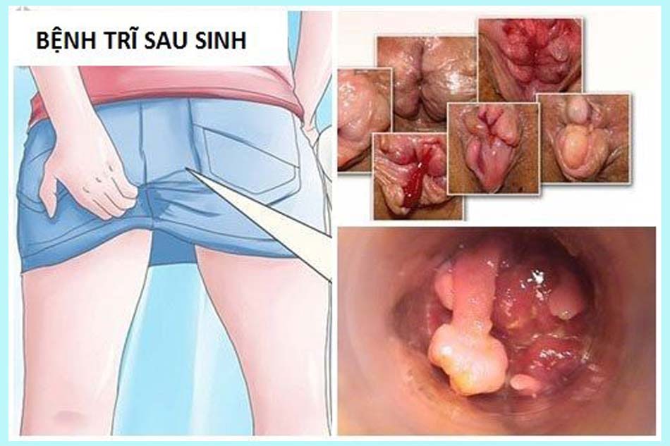 Bệnh trĩ - Nguyên nhân dẫn đến lòi dom sau sinh