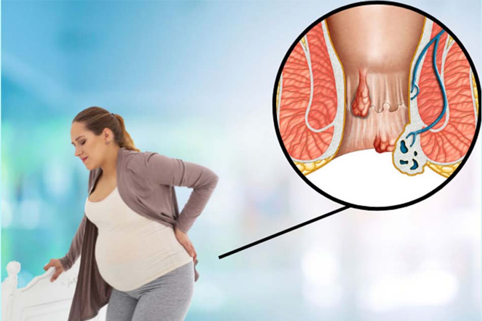 Bệnh lòi dom ở phụ nữ sau sinh là gì? Dấu hiệu nhận biết