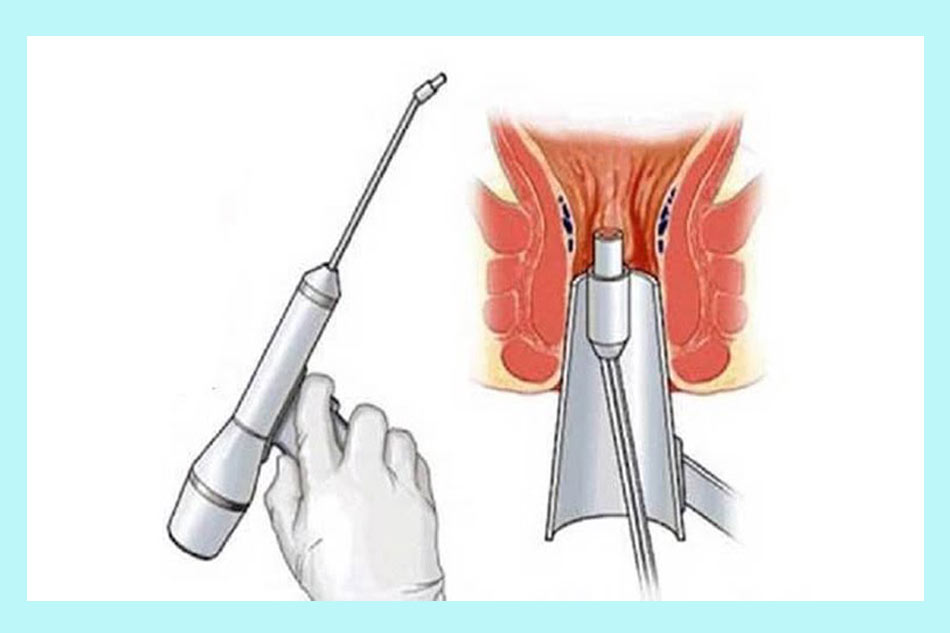 Cắt trĩ bằng laser