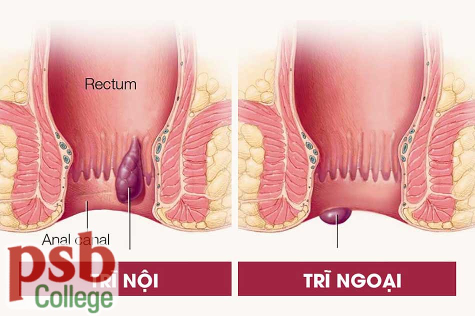 Trĩ nội - Trĩ ngoại