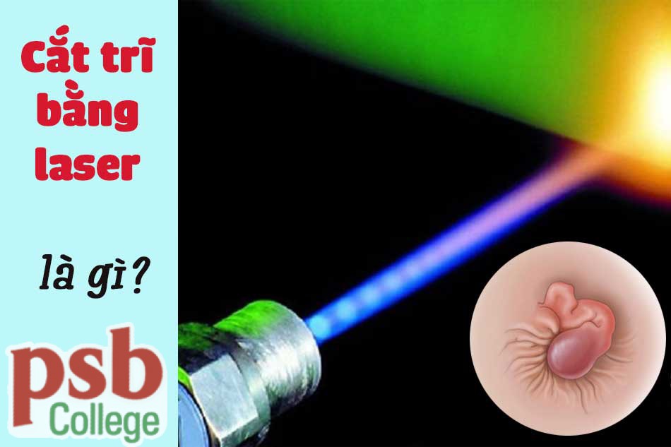 Cắt trĩ bằng laser là gì?