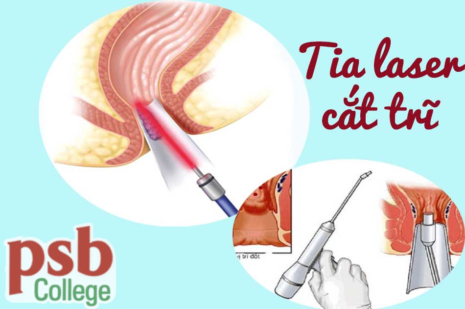 Cắt trĩ bằng laser