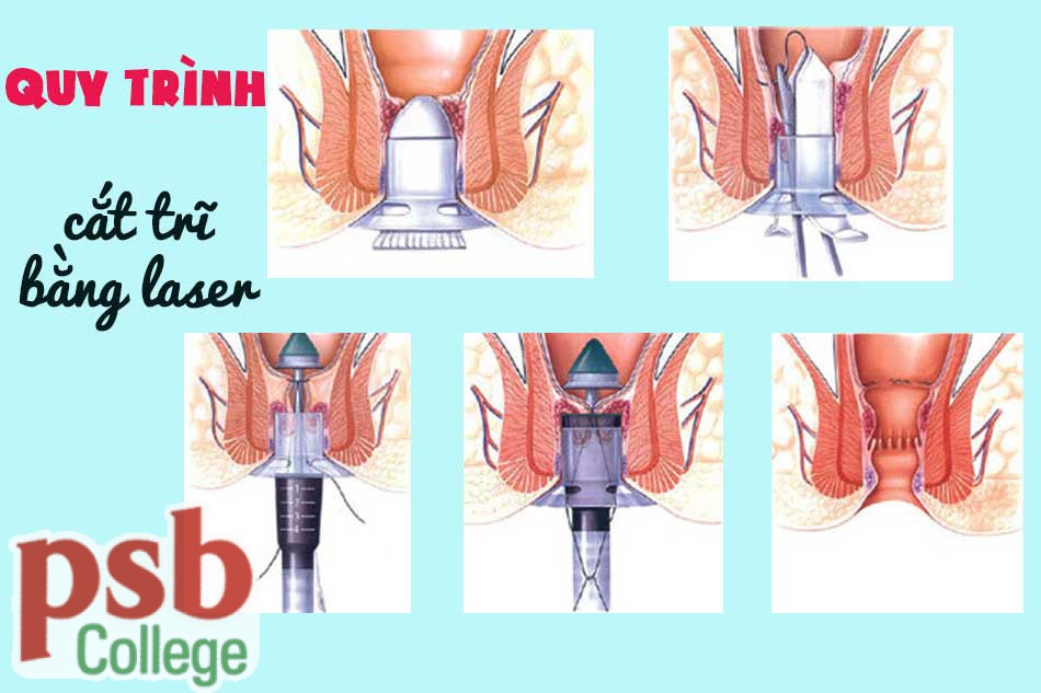 Quy trình cắt trĩ bằng laser