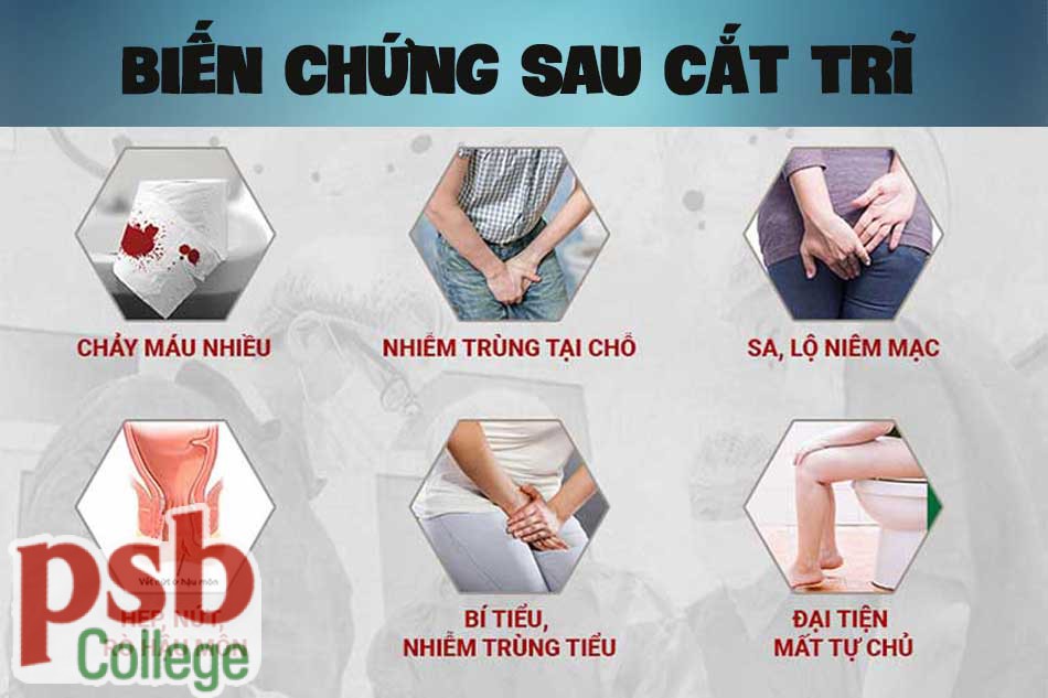 Biến chứng sau phẫu thuật cắt trĩ
