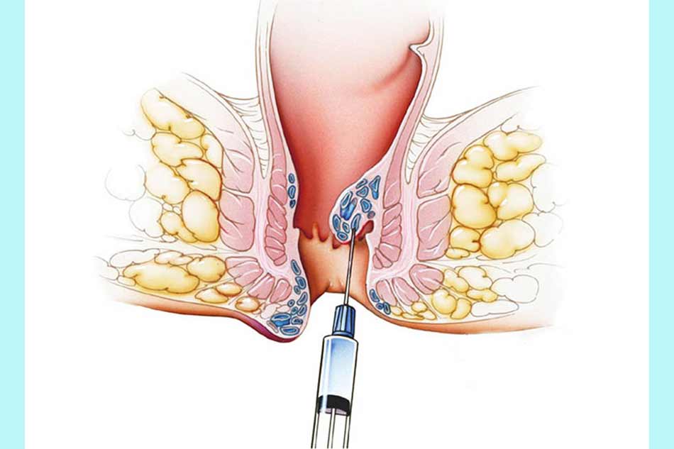 Chích xơ búi trĩ là gì?