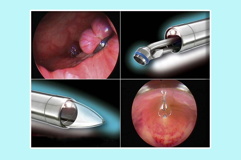 Chích xơ búi trĩ có ưu nhược điểm như thế nào?
