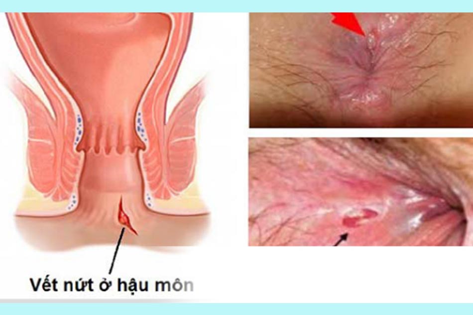 Nứt kẽ hậu môn