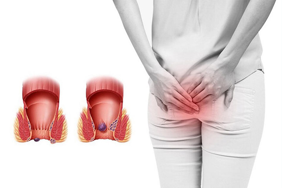 Đau hậu môn vô căn là dấu hiệu bệnh gì?