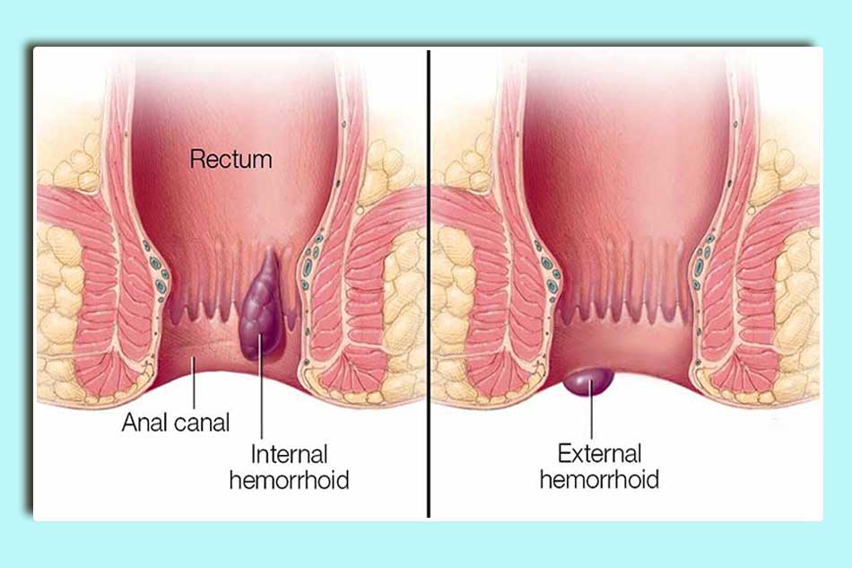 Đi ngoài ra máu là dấu hiệu bệnh trĩ