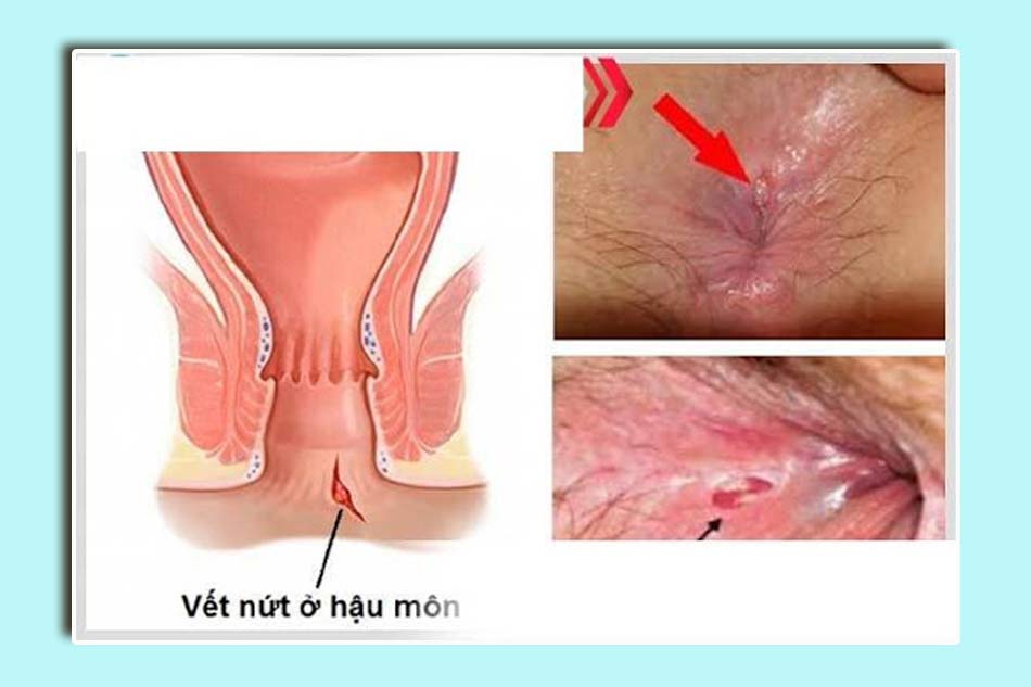 Nứt kẽ hậu môn