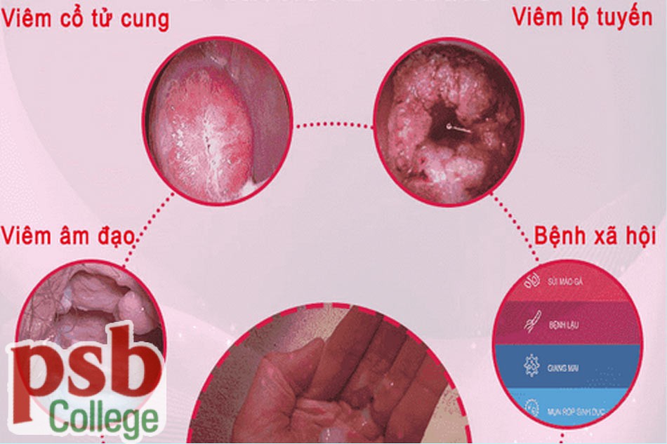 Nguyên nhân gây ra bệnh huyết trắng