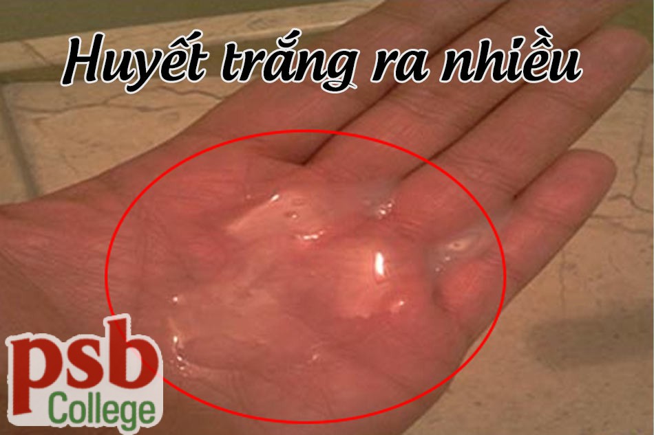 Cần làm gì khi huyết trắng ra nhiều