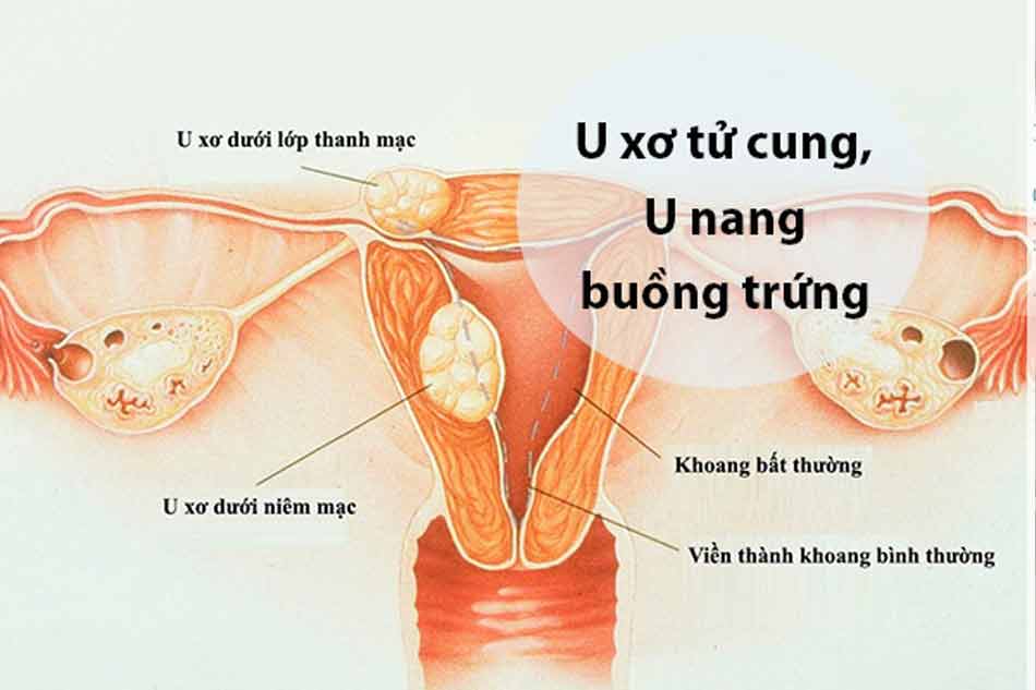 Khang Nữ Hoàn Nguyên Đan dùng được cho phụ nữ bị u xơ tử cung