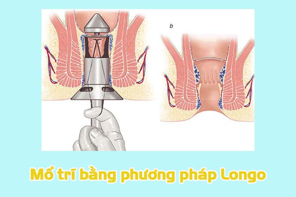 Một số phương pháp mổ trĩ