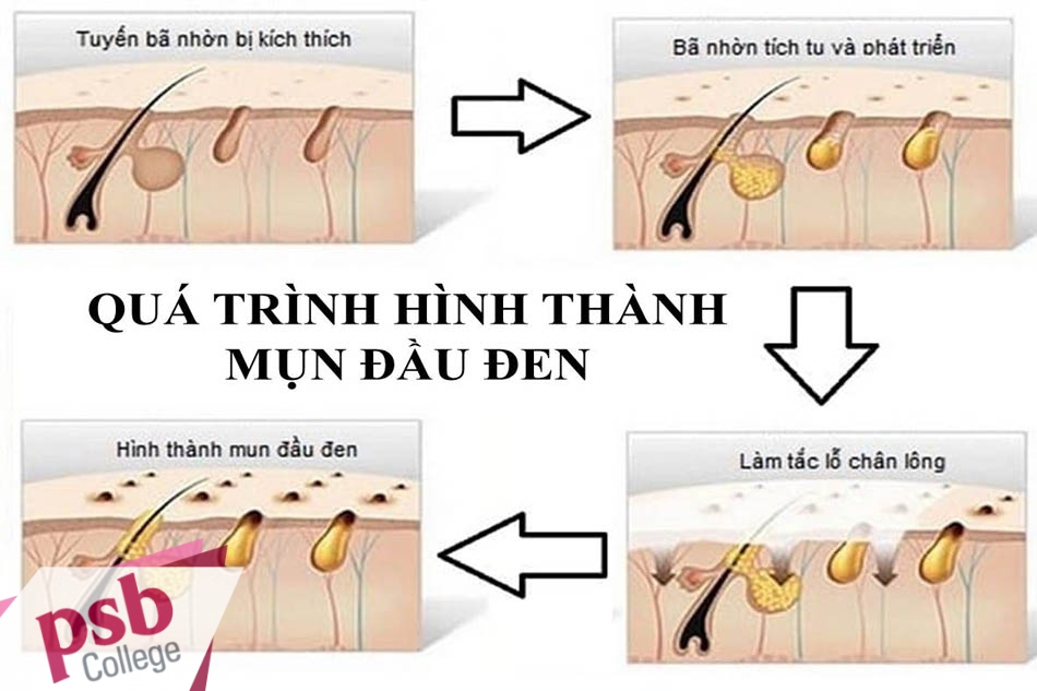 Cơ chế hình thành mụn đầu đen