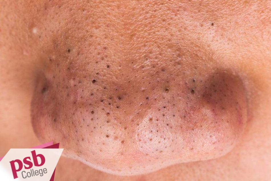 Mụn đầu đen khô không sưng đó, đầu màu đen do tuyến bã bị tắc.