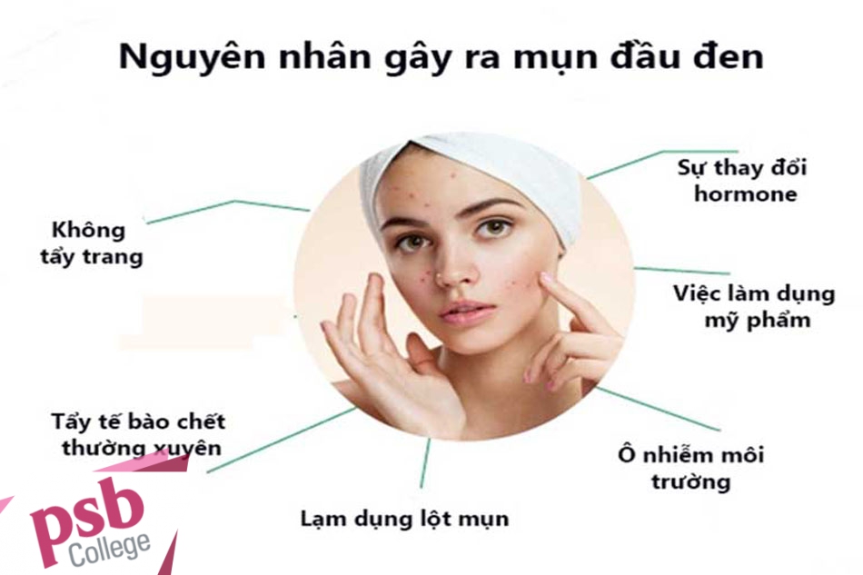 Những nguyên nhân chính gây mụn đầu đen