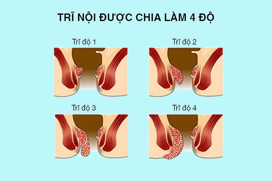 Phân loại cấp độ trĩ
