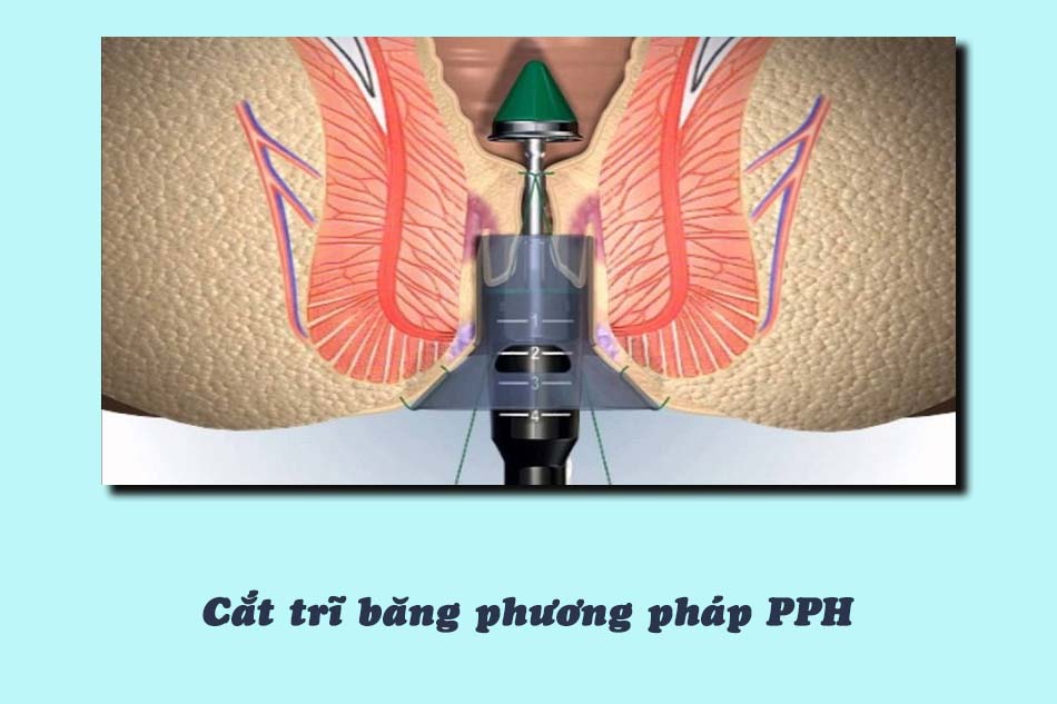 Cắt trĩ bằng phương pháp PPH