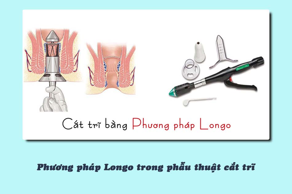 Phương pháp Longo trong phẫu thuật cắt trĩ