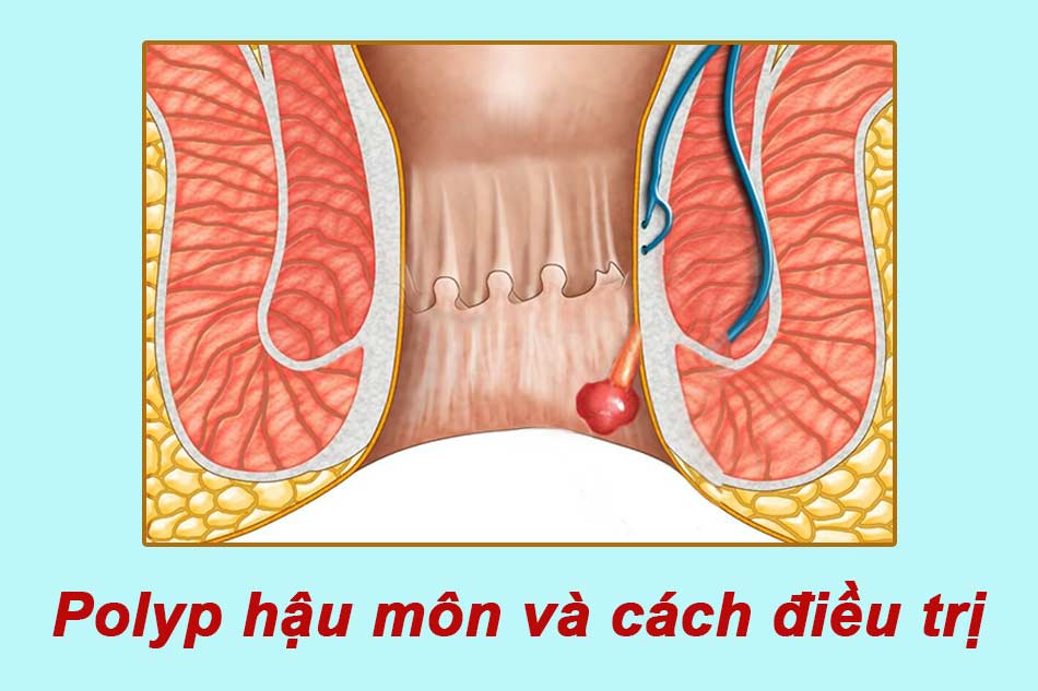 Polyp hậu môn