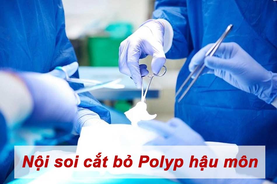 Nội soi cắt bỏ Polyp hậu môn