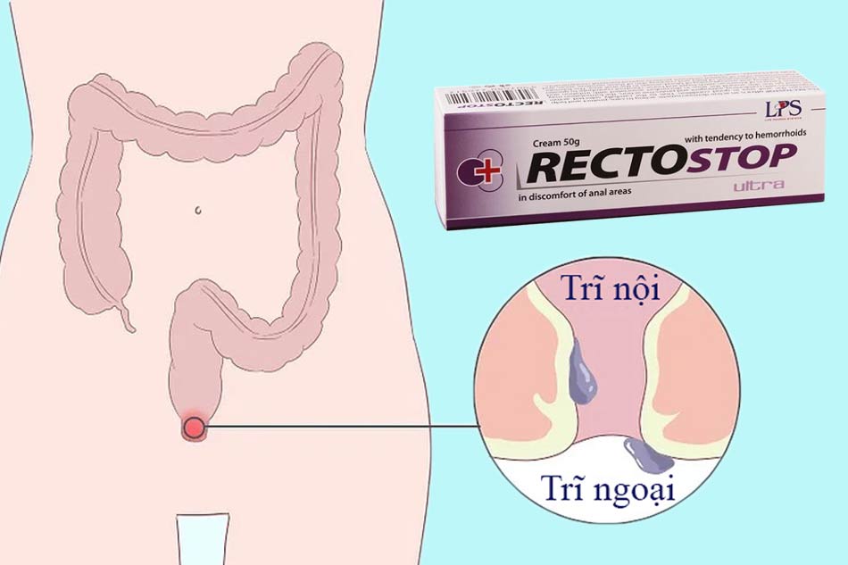 Hình ảnh Rectostop