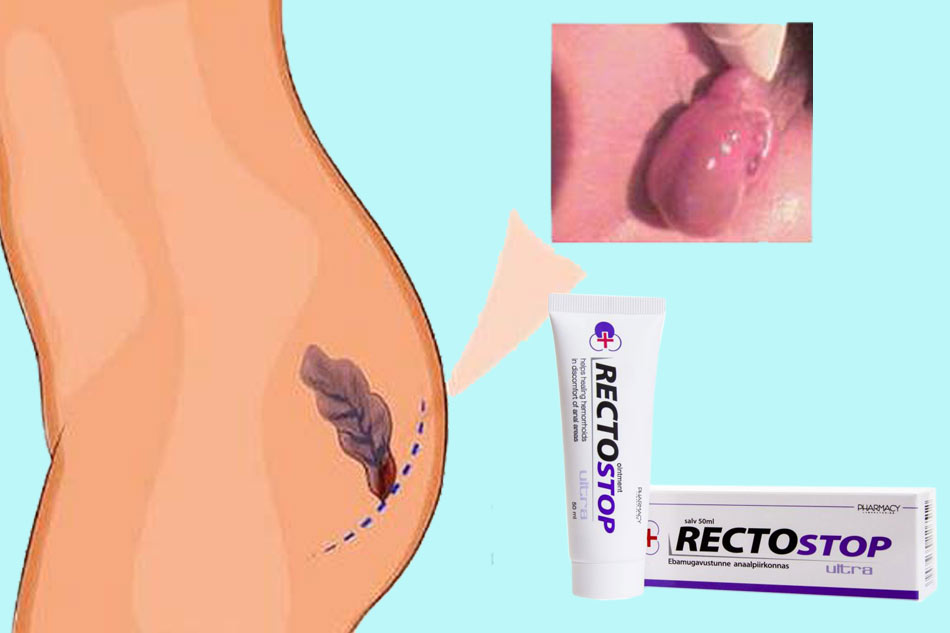 Hình ảnh Rectostop