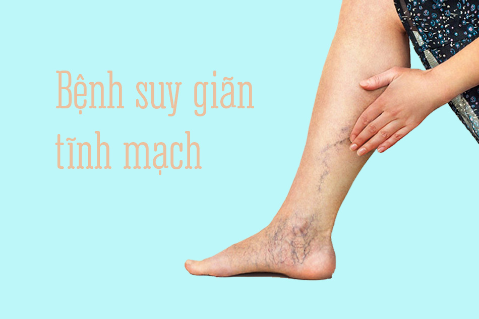 Bệnh suy giãn tĩnh mạch ở chân