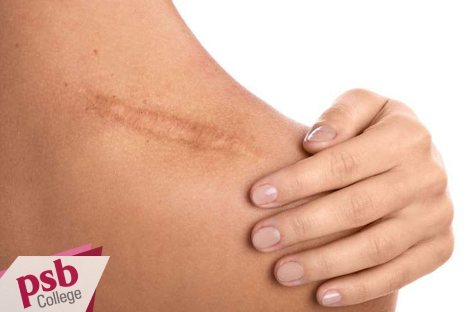 Sẹo lồi hình thành do vết thương