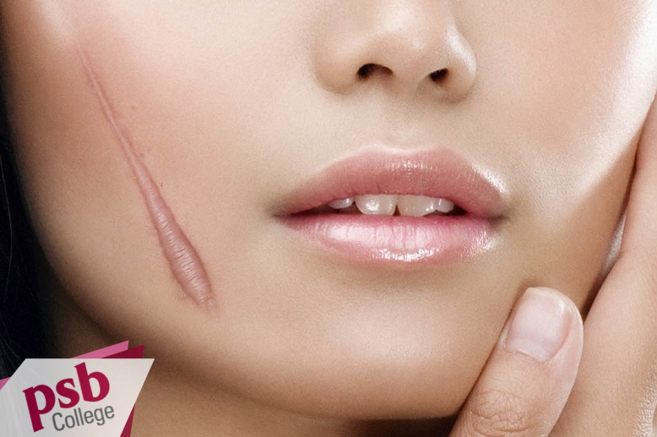 Sẹo lồi phát triển vượt qua cả phạm vi vết thương ban đầu